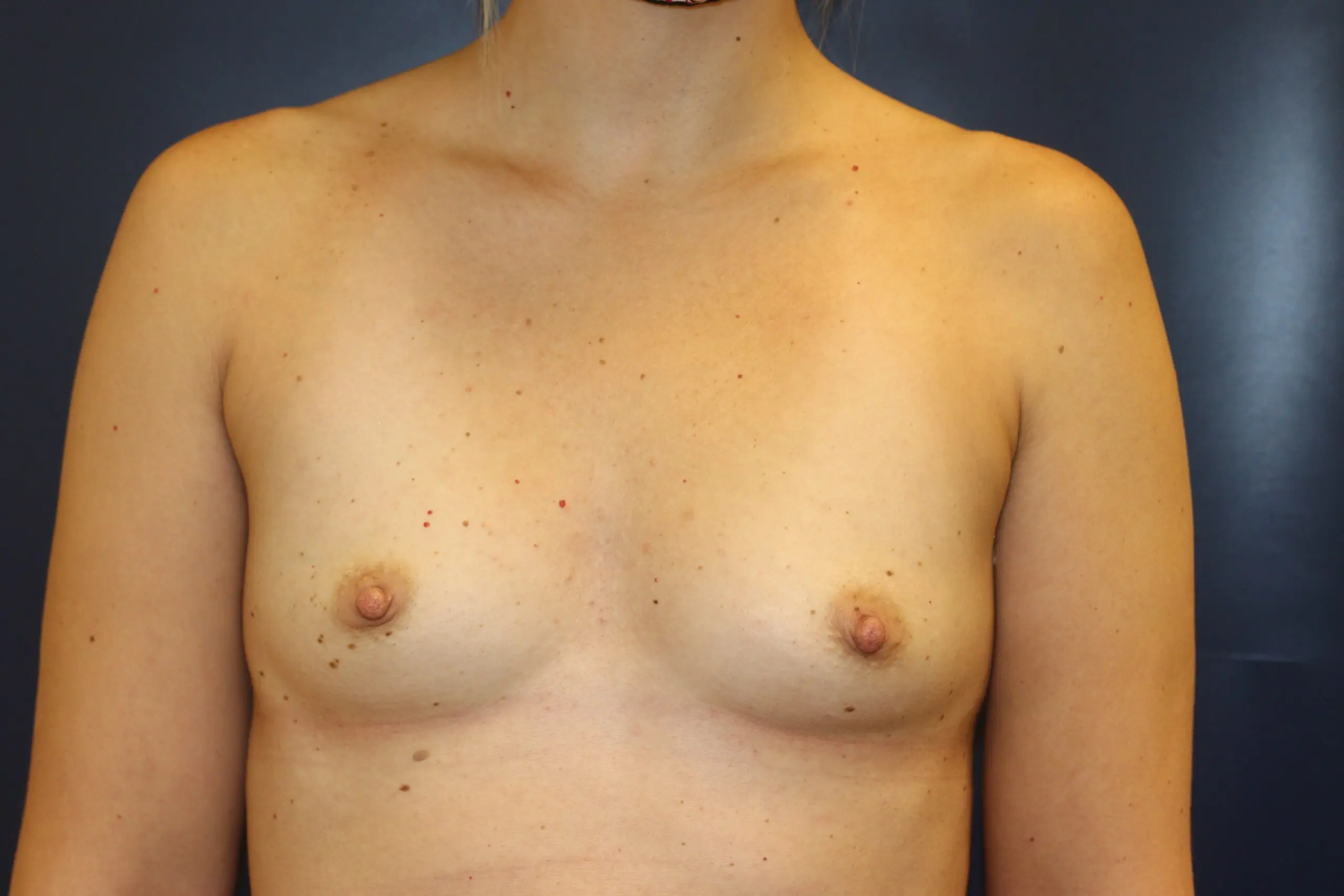 Case-10-Breast-Augmentation-Before-scaled