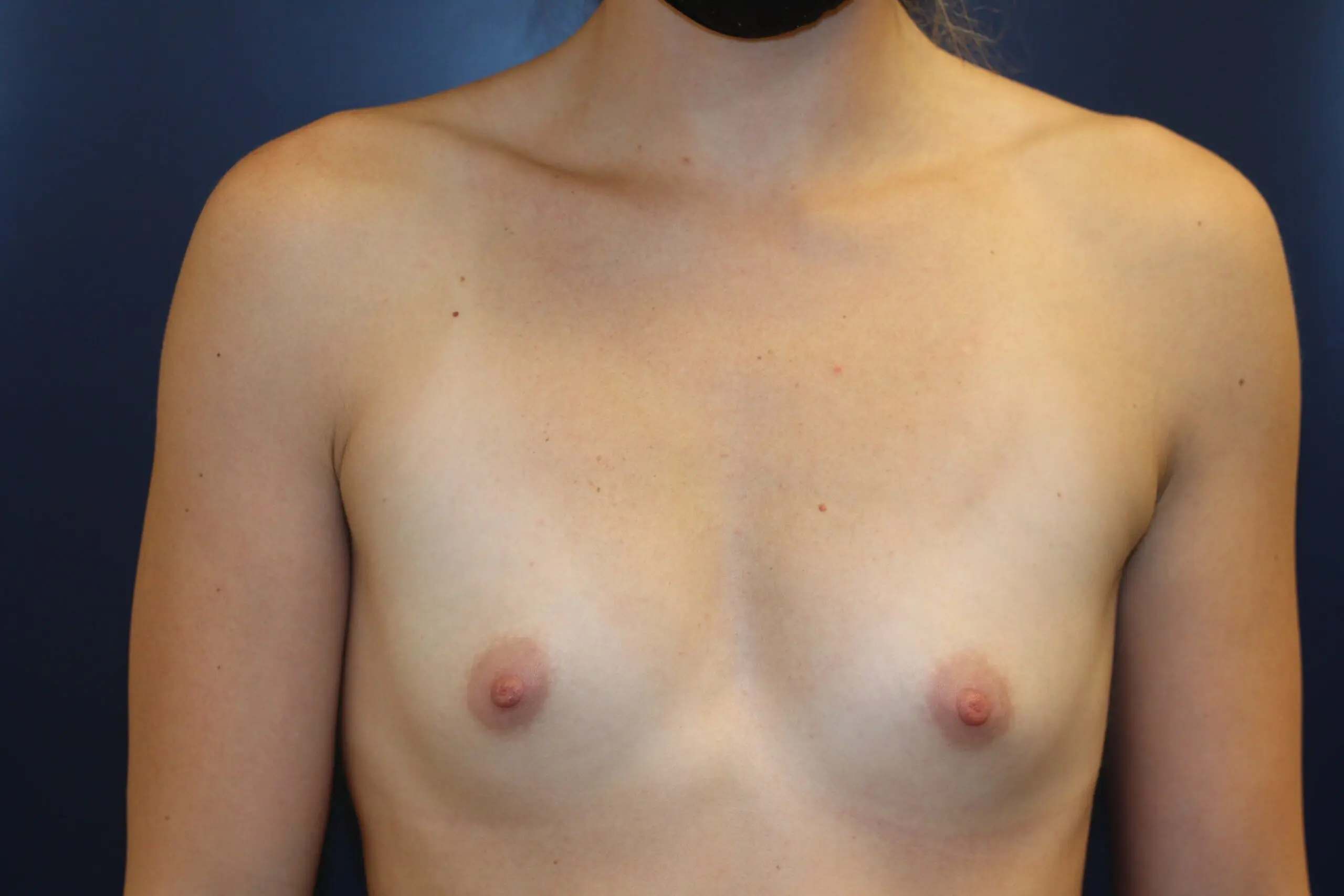 Case-11-Breast-Augmentation-Before-scaled