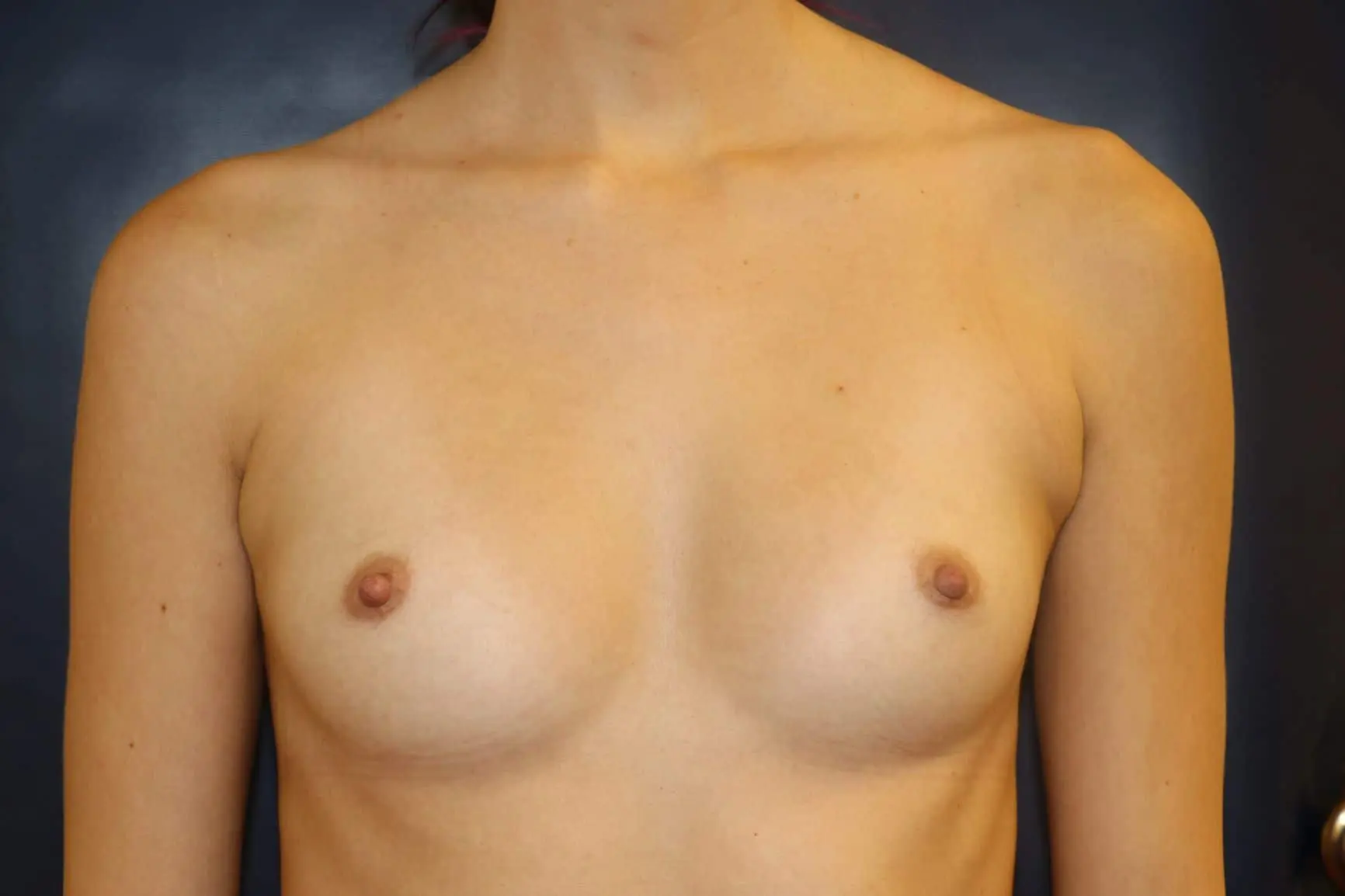 Case-7-Breast-Augmentation-Before6