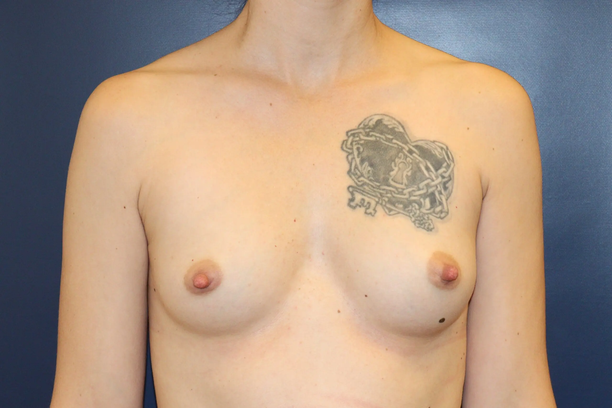 Case-9-Bilateral-Breast-Augmentation-Before-scaled