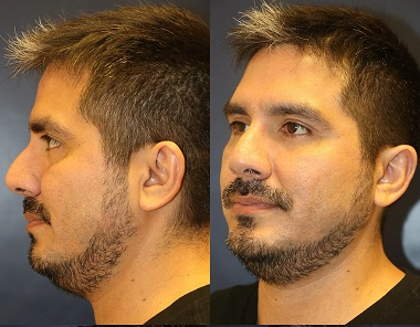 1-Rhinoplasty-Submental-liposuction_-scaled
