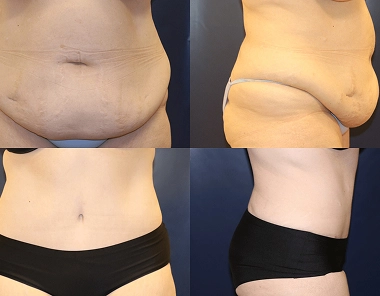 Abdominoplasty banner