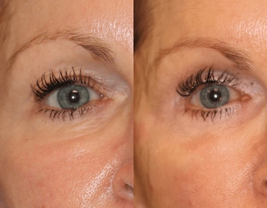 In office Upper Lid Blepharoplasty